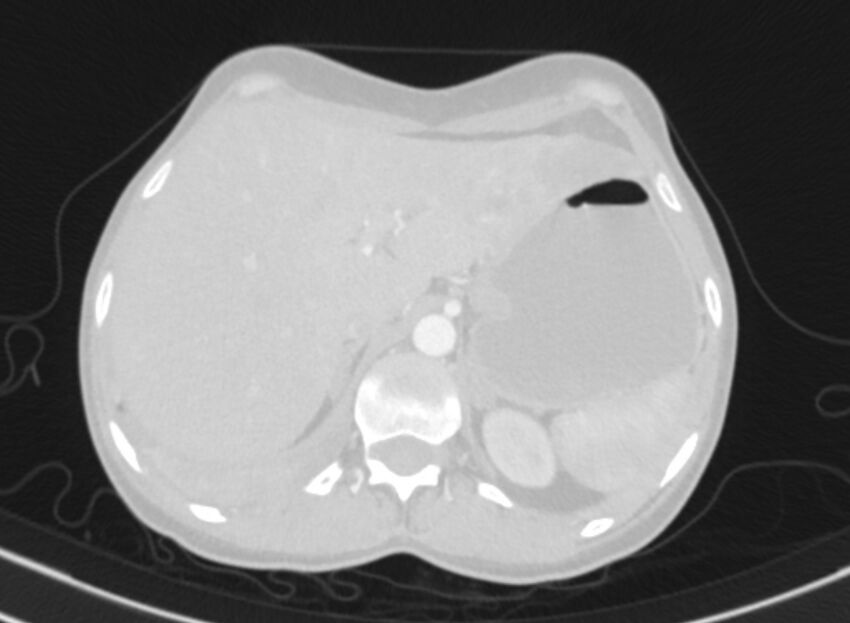 Cannonball metastases from breast cancer (Radiopaedia 91024-108569 Axial lung window 100).jpg
