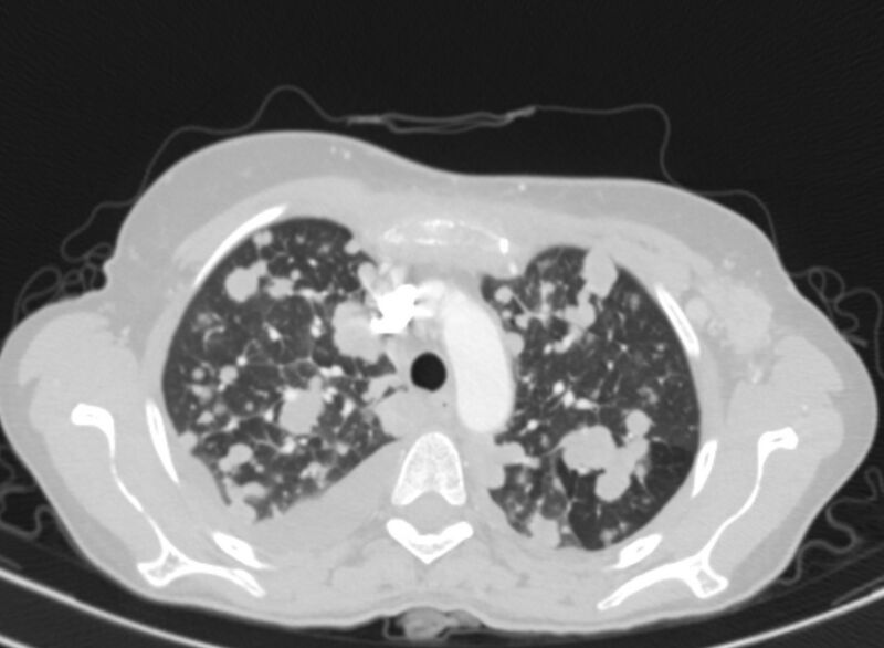File:Cannonball metastases from breast cancer (Radiopaedia 91024-108569 Axial lung window 22).jpg