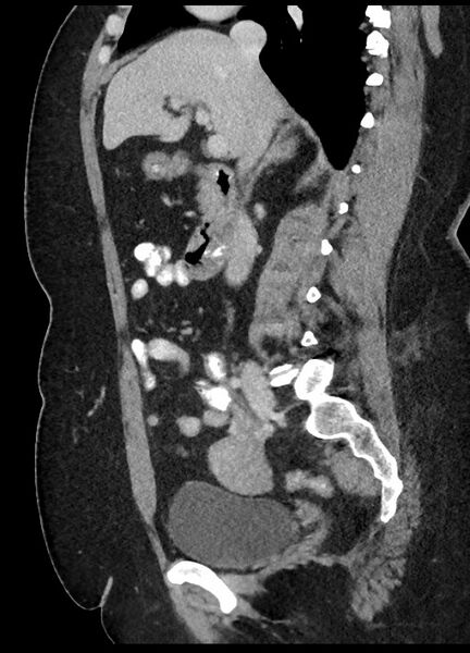 File:Carcinoid tumor - terminal ileum (Radiopaedia 60931-68739 C 58).jpg