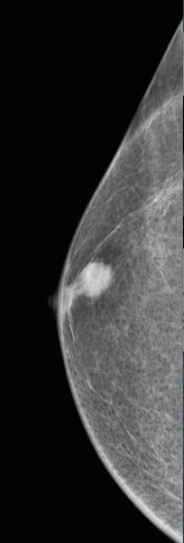 File:Carcinoma of right breast (Radiopaedia 30195-30810 CC 1).png