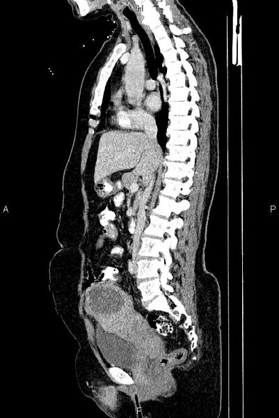 File:Carcinoma of uterine cervix (Radiopaedia 85861-101700 D 38).jpg