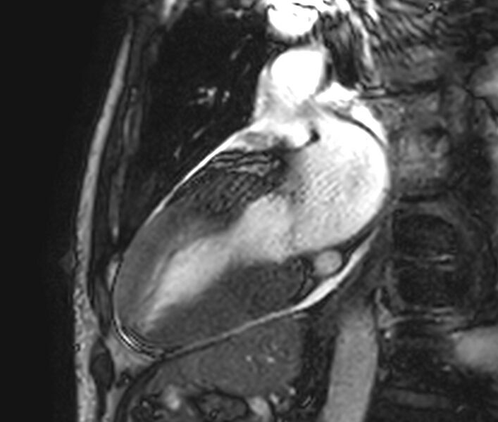 File:Cardiac amyloidosis (Radiopaedia 39736-42124 B 5).jpg