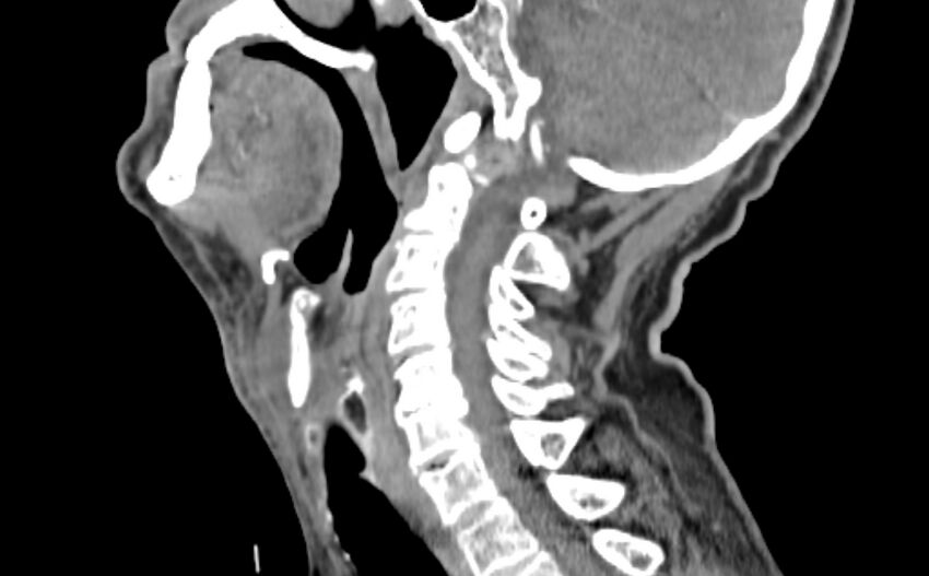 Carotid artery pseudoaneurysm (Radiopaedia 84030-99259 E 3).jpg