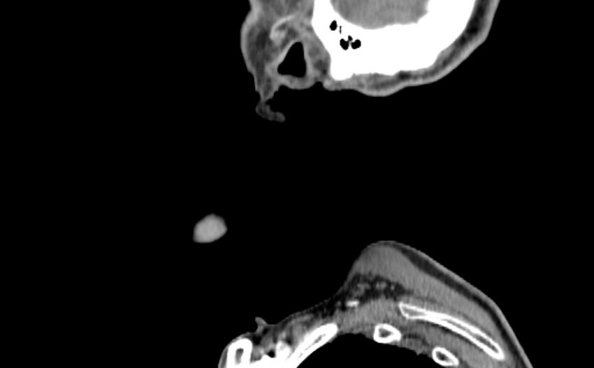 Carotid artery pseudoaneurysm (Radiopaedia 84030-99259 E 69).jpg