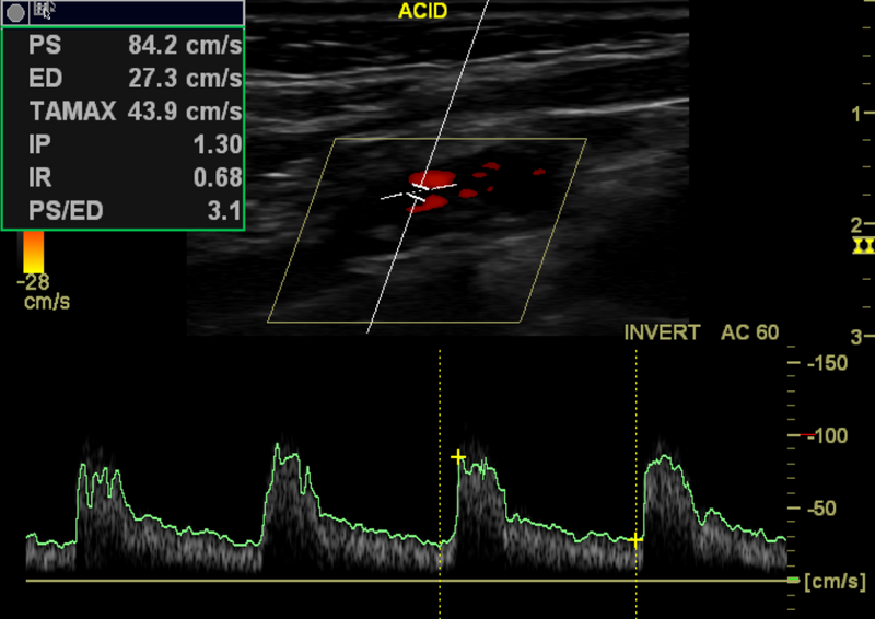 File:Carotid artery stenosis (Radiopaedia 28786-29088 E 1).png
