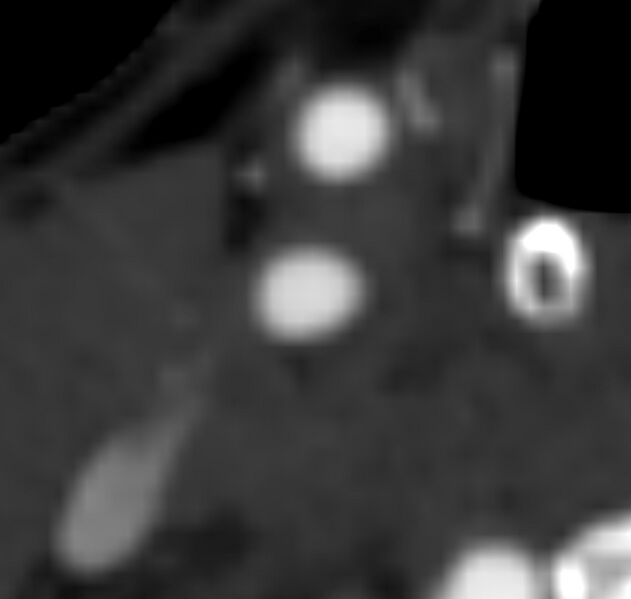 File:Carotid near-occlusion (Radiopaedia 85304-100887 M 49).jpg