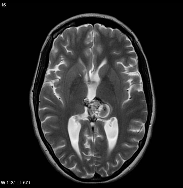 File:Cavernous malformation of the midbrain (Radiopaedia 7791-8615 Axial T2 5).jpg