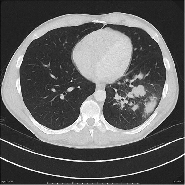 File:Cavitating lung cancer (Radiopaedia 25796-25945 Axial lung window 39).jpg