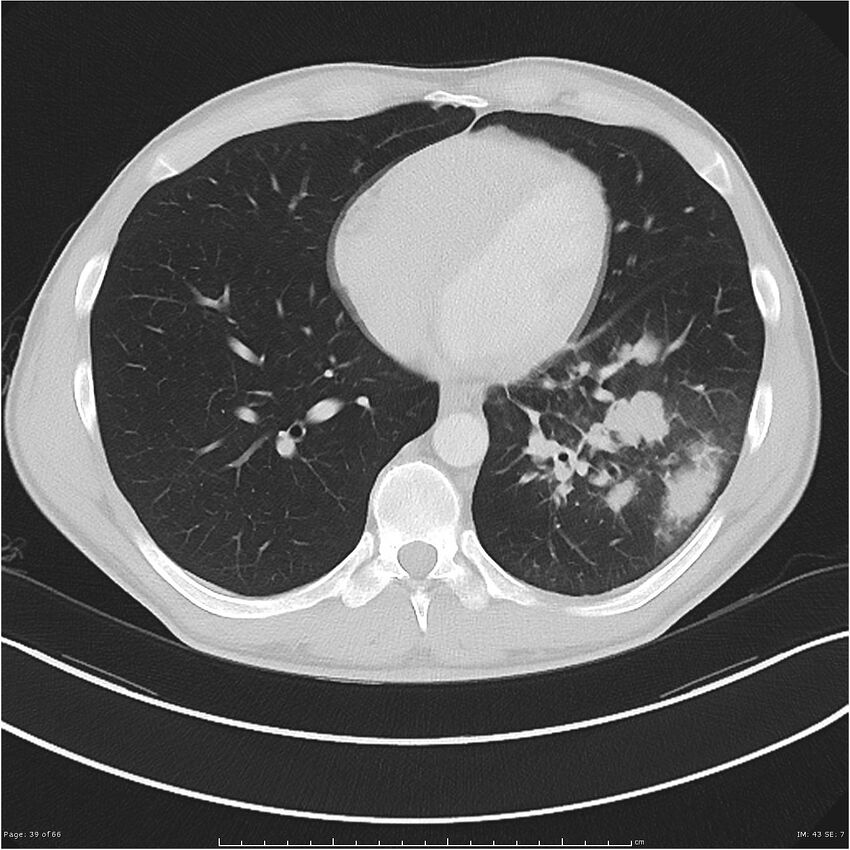 Cavitating lung cancer (Radiopaedia 25796-25945 Axial lung window 39).jpg