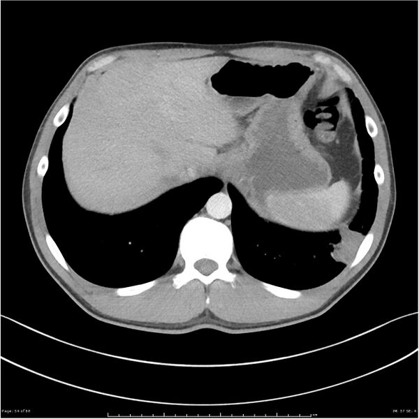 File:Cavitating lung cancer (Radiopaedia 25796-25945 C+ arterial phase 54).jpg