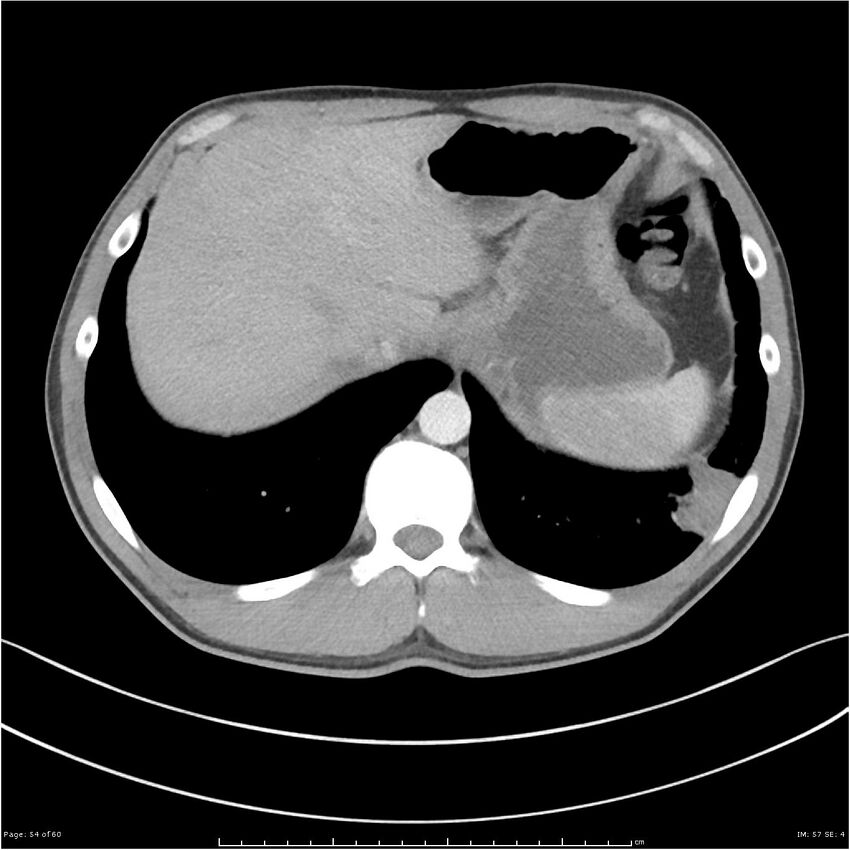 Cavitating lung cancer (Radiopaedia 25796-25945 C+ arterial phase 54).jpg