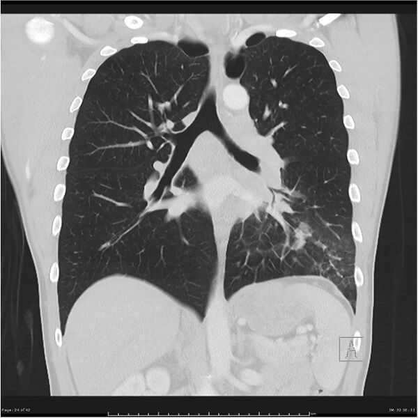File:Cavitating lung cancer (Radiopaedia 25796-25945 lung window 24).jpg