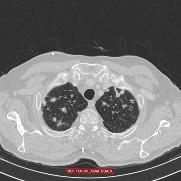 File:Cavitating pulmonary metastases (Radiopaedia 24920-25184 Axial lung window 2).jpg