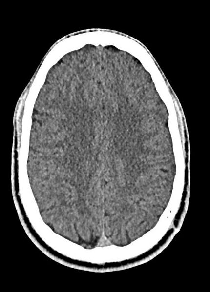 File:Cavum septum pellucidum and cavum vergae (Radiopaedia 77797-90060 Axial Brain Window 73).jpg