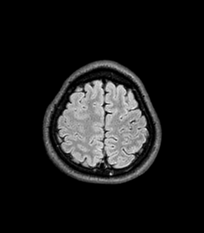 Central neurocytoma (Radiopaedia 79320-92380 Axial FLAIR 66).jpg