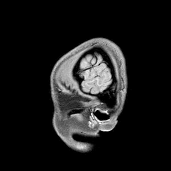 File:Central neurocytoma (Radiopaedia 79320-92380 Sagittal T1 24).jpg