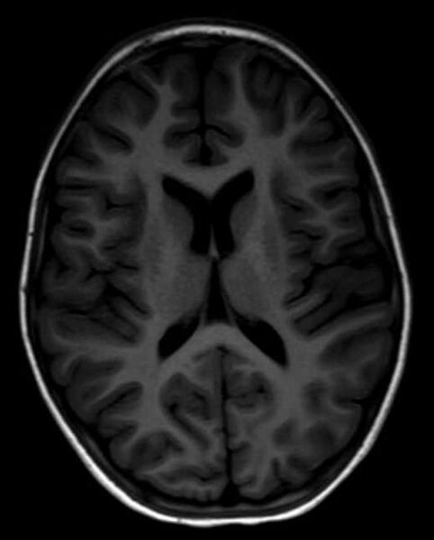 File:Cerebellar abscess (Radiopaedia 73727-84563 Axial T1 20).jpg