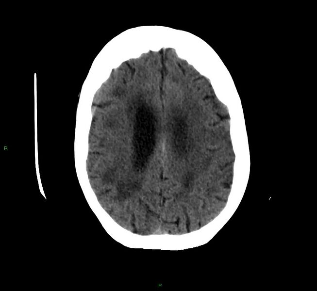 File:Cerebellar hemorrhage (Radiopaedia 58792-66026 Axial non-contrast 17).jpg