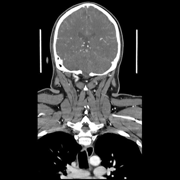 File:Cerebellar infarct due to vertebral artery dissection with posterior fossa decompression (Radiopaedia 82779-97029 D 42).png