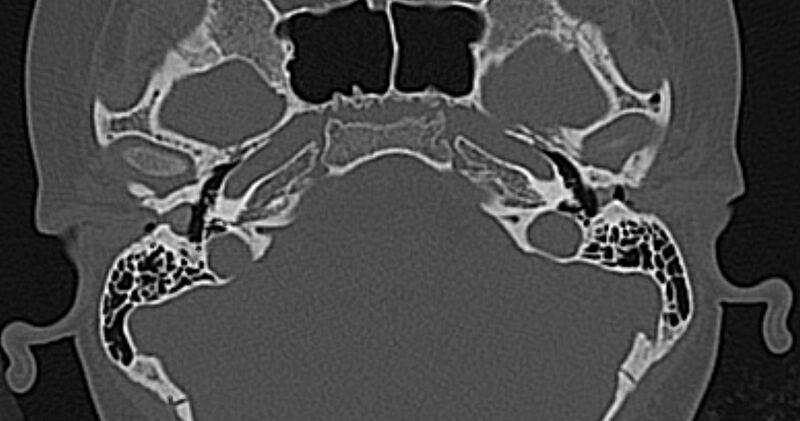 File:Cerebellopontine angle lipoma (Radiopaedia 57303-64242 Axial bone window 18).jpg