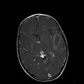 Cerebral abscess post cardiac surgery (Radiopaedia 27244-27420 Axial T1 C+ 11).jpg