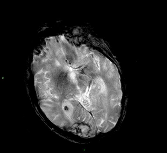 File:Cerebral amyloid angiopathy-associated lobar intracerebral hemorrhage (Radiopaedia 58377-65515 Axial Gradient Echo 15).jpg