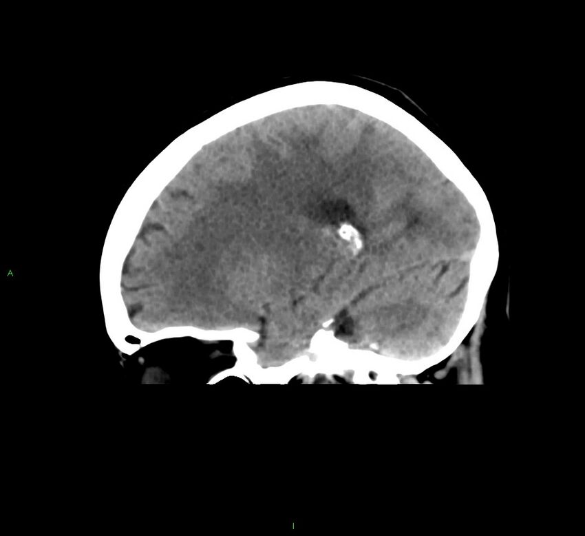 Cerebral amyloid angiopathy-associated lobar intracerebral hemorrhage (Radiopaedia 58378-65516 C 19).jpg