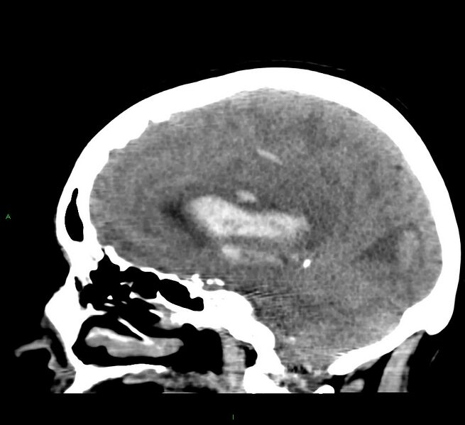 File:Cerebral amyloid angiopathy-associated lobar intracerebral hemorrhage (Radiopaedia 58379-65519 C 31).jpg