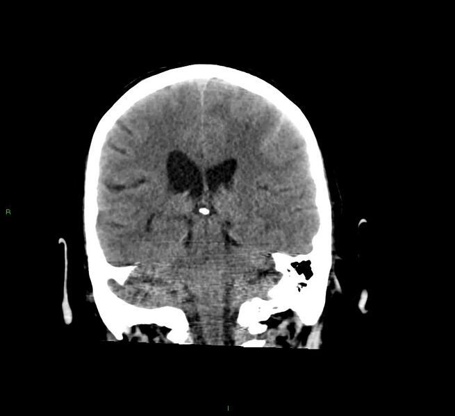 File:Cerebral amyloid angiopathy-associated lobar intracerebral hemorrhage (Radiopaedia 58529-65681 Coronal non-contrast 28).jpg