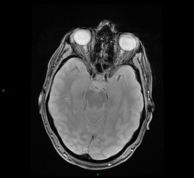 File:Cerebral amyloid angiopathy-associated lobar intracerebral hemorrhage (Radiopaedia 58529-65684 Axial Gradient Echo 10).jpg