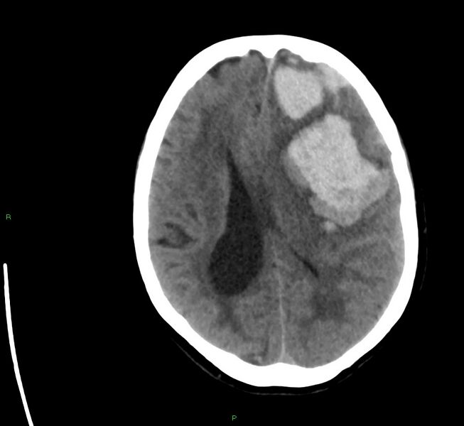 File:Cerebral amyloid angiopathy-associated lobar intracerebral hemorrhage (Radiopaedia 58561-65724 Axial non-contrast 19).jpg