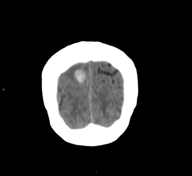 File:Cerebral amyloid angiopathy-associated lobar intracerebral hemorrhage (Radiopaedia 58751-65972 Coronal non-contrast 8).jpg