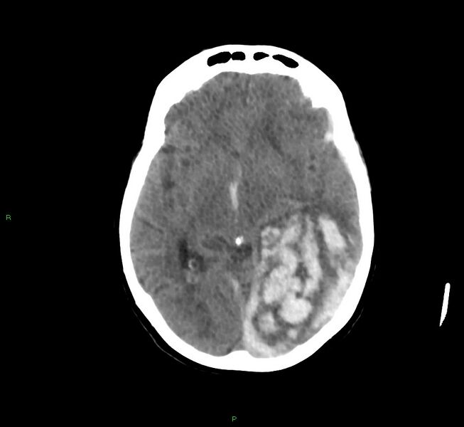 File:Cerebral amyloid angiopathy-associated lobar intracerebral hemorrhage (Radiopaedia 58754-65975 Axial non-contrast 36).jpg