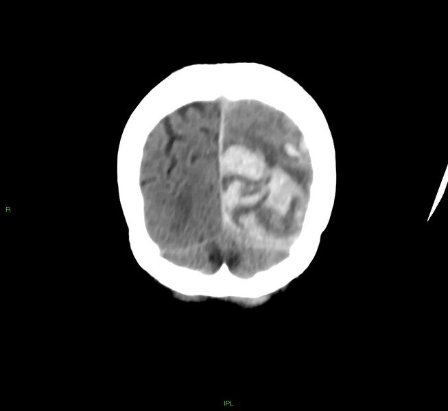 File:Cerebral amyloid angiopathy-associated lobar intracerebral hemorrhage (Radiopaedia 58754-65975 Coronal non-contrast 11).jpg