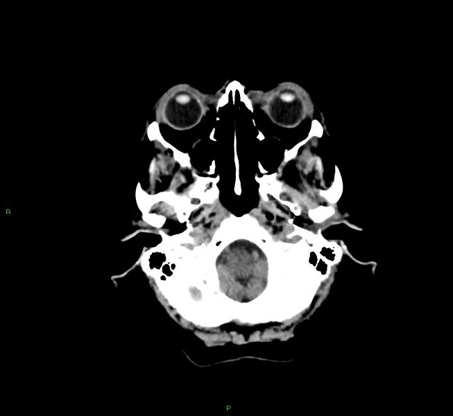 File:Cerebral amyloid angiopathy-associated lobar intracerebral hemorrhage (Radiopaedia 58757-65978 Axial non-contrast 44).jpg