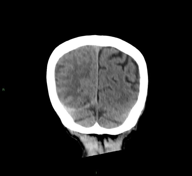 File:Cerebral amyloid angiopathy-associated lobar intracerebral hemorrhage (Radiopaedia 58758-65980 Coronal non-contrast 14).jpg