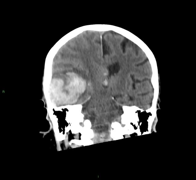 File:Cerebral amyloid angiopathy-associated lobar intracerebral hemorrhage (Radiopaedia 58758-65980 Coronal non-contrast 30).jpg