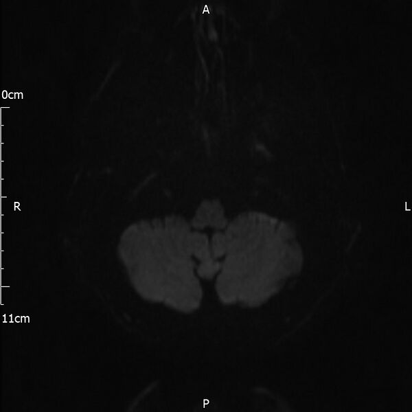 File:Cerebral amyloid angiopathy related inflammation (Radiopaedia 72772-83415 Axial DWI 51).jpg