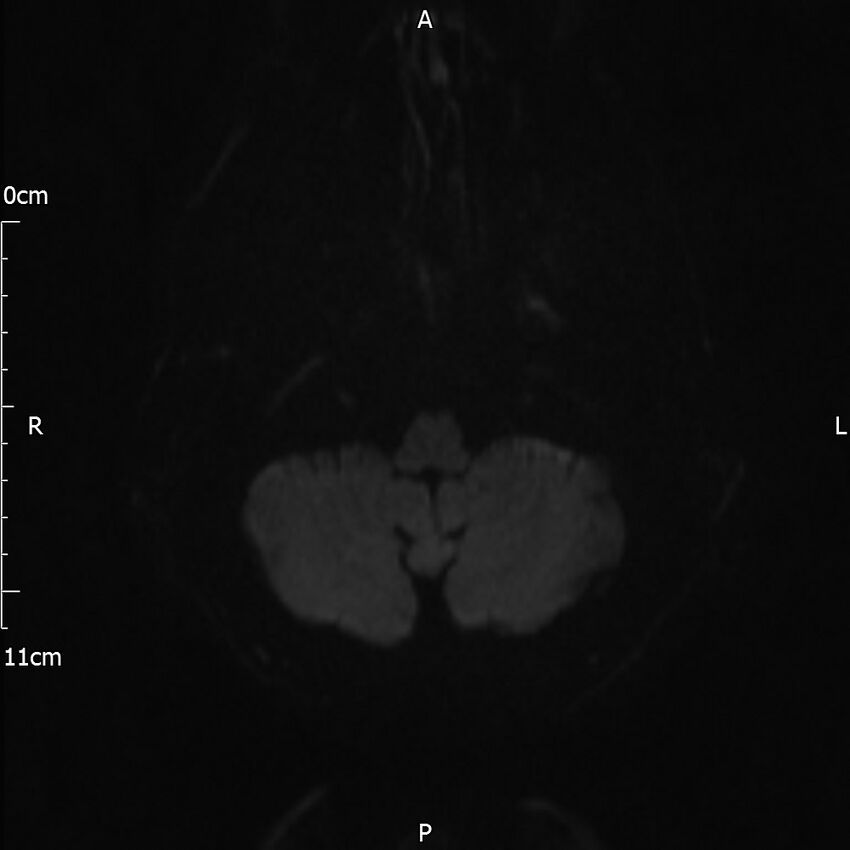 Cerebral amyloid angiopathy related inflammation (Radiopaedia 72772-83415 Axial DWI 51).jpg