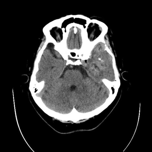 File:Cerebral arteriovenous malformation (Radiopaedia 43729-47189 Axial non-contrast 11).jpg