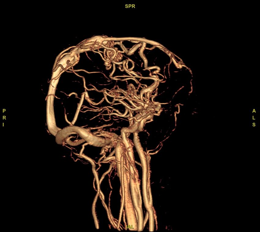 Cerebral arteriovenous malformation (Radiopaedia 61964-70029 VRT 30).jpg