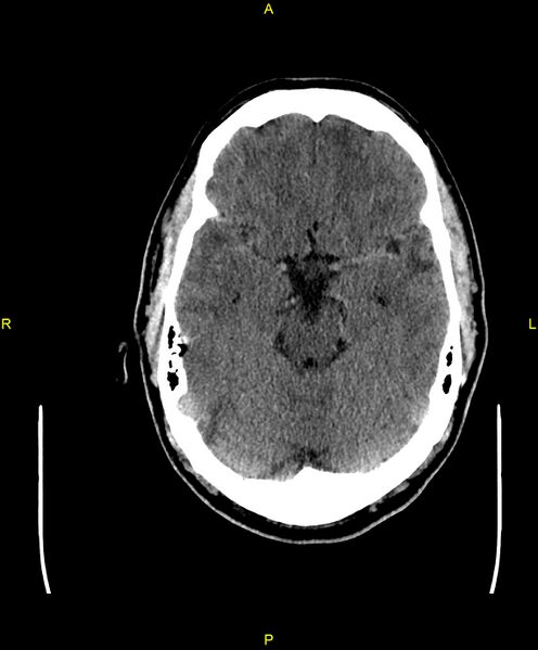 File:Cerebral autosomal dominant arteriopathy with subcortical infarcts and leukoencephalopathy (CADASIL) (Radiopaedia 86108-102051 Axial non-contrast 37).jpg