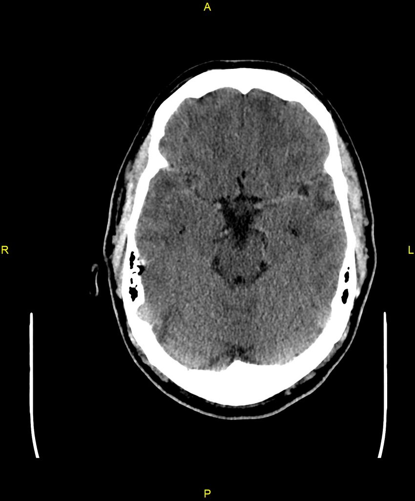 Cerebral autosomal dominant arteriopathy with subcortical infarcts and leukoencephalopathy (CADASIL) (Radiopaedia 86108-102051 Axial non-contrast 37).jpg