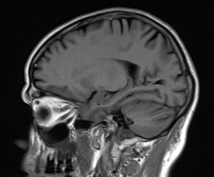 File:Cerebral venous thrombosis (Radiopaedia 71207-81504 Sagittal T1 17).jpg