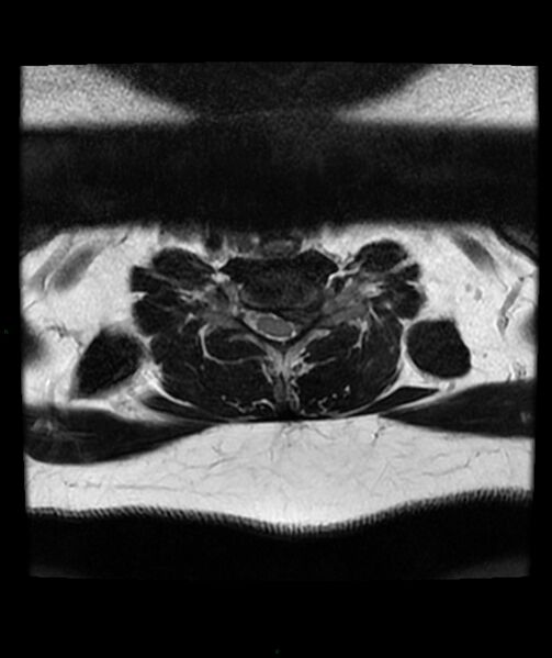 File:Cervical disc prolapse (Radiopaedia 80258-93598 Axial T2 59).jpg