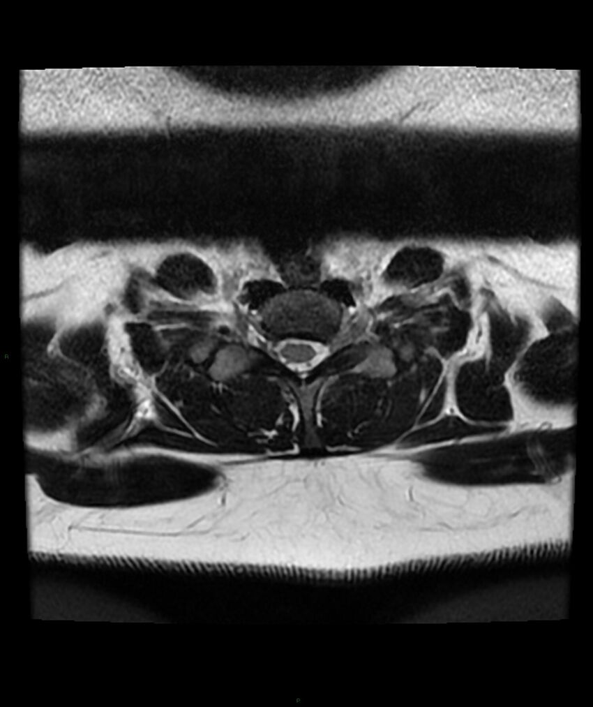 Cervical disc prolapse (Radiopaedia 80258-93598 Axial T2 72).jpg