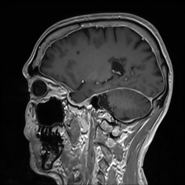 File:Cervical dural CSF leak on MRI and CT treated by blood patch (Radiopaedia 49748-54995 G 77).jpg