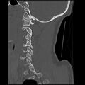Cervical flexion teardrop fracture with cord hemorrhage (Radiopaedia 32497-33454 Sagittal bone window 12).jpg