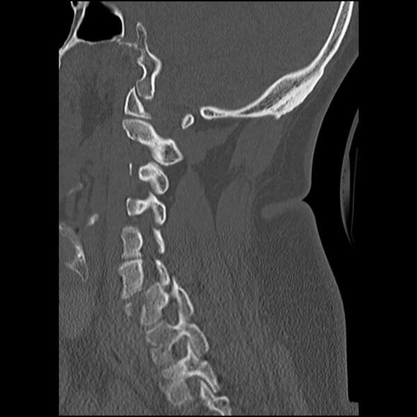 File:Cervical fracture and dislocation with locked facet (Radiopaedia 31837-32780 Sagittal bone window 23).jpg
