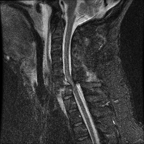 File:Cervical fracture and dislocation with locked facet (Radiopaedia 31837-32781 Sagittal STIR 9).jpg